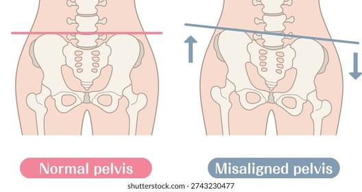 misaligned pelvis construction